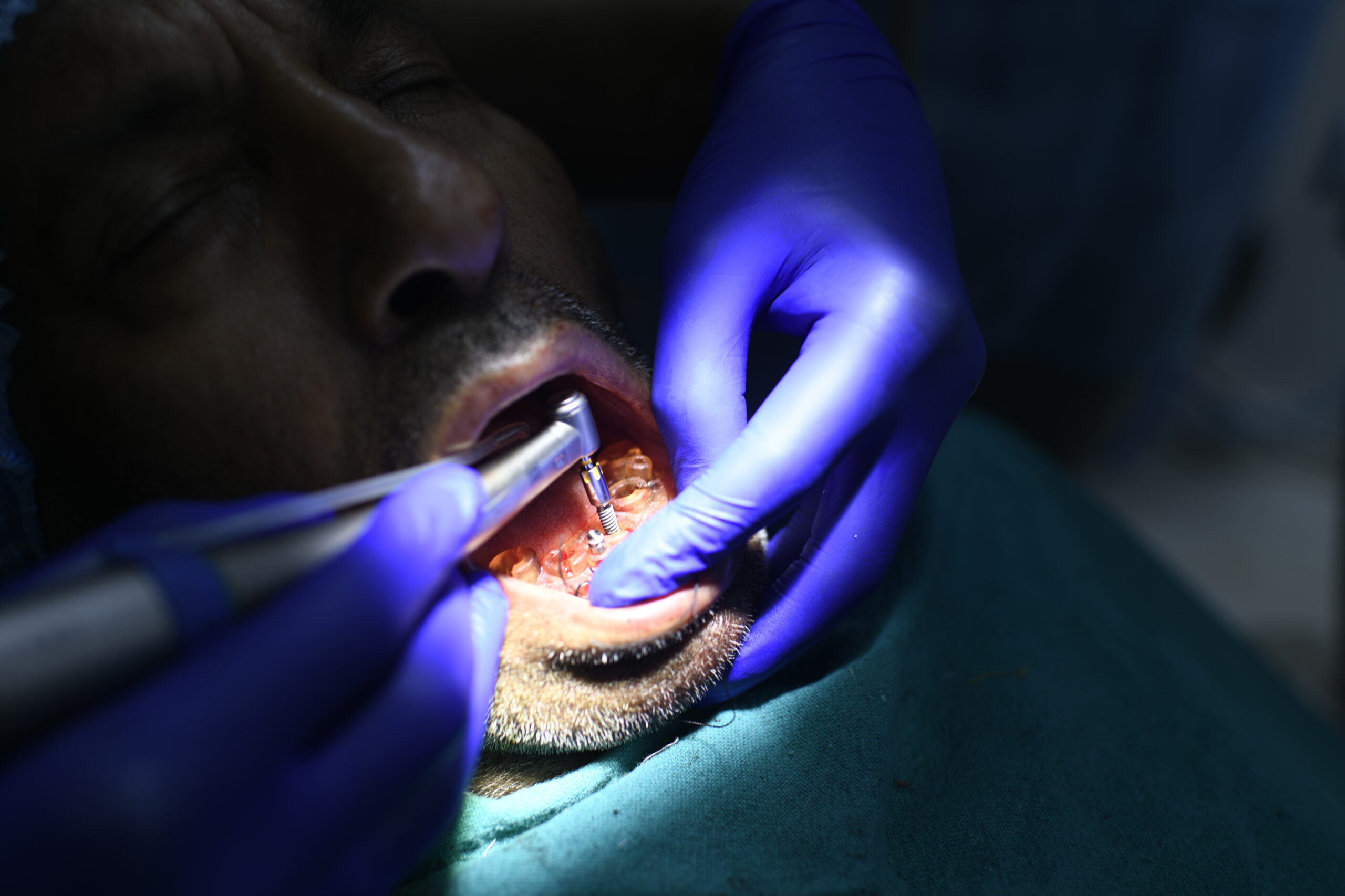 sinus lift and bone grafting / endocare