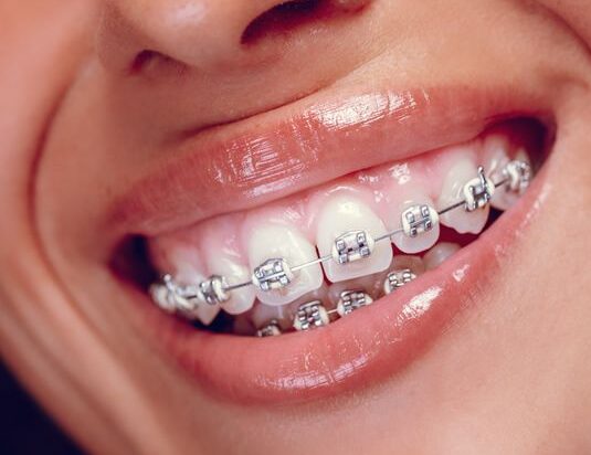 How Long Does Orthodontic Treatment Take For Braces ShineSheets Elevate Your Life e1748772842699