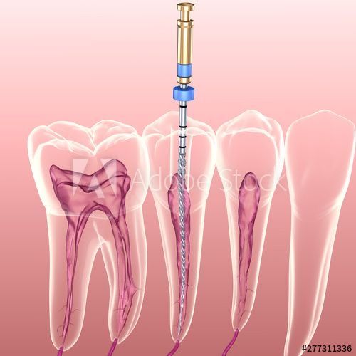 “Root canal treatment at Endocare Dental, Lucknow”.