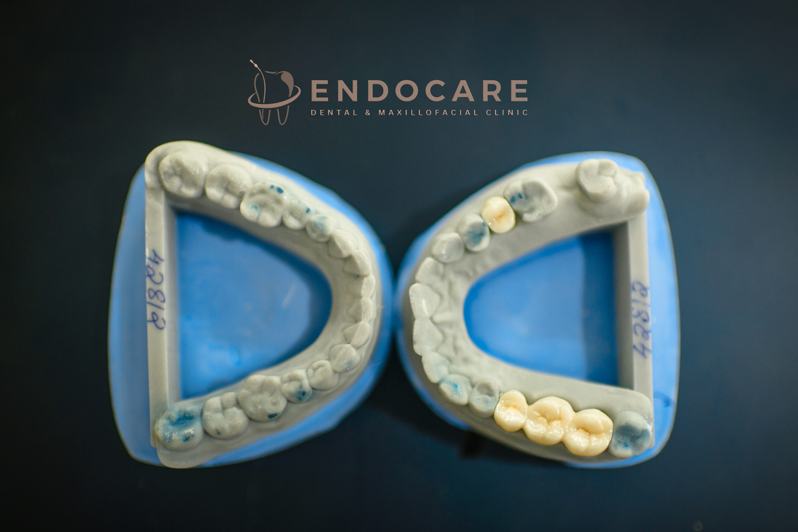 Digital capping/ endocare
