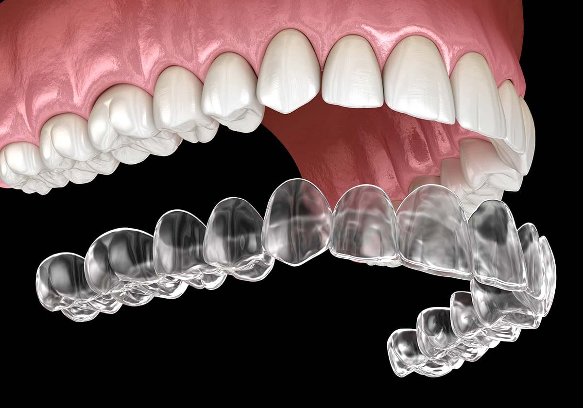 aligners / endocare