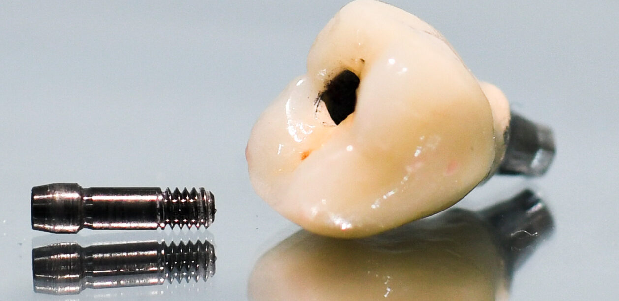 Dental Implants / endocare