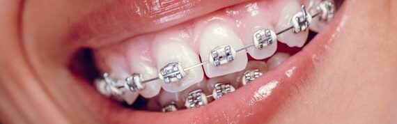 Braces / endocare