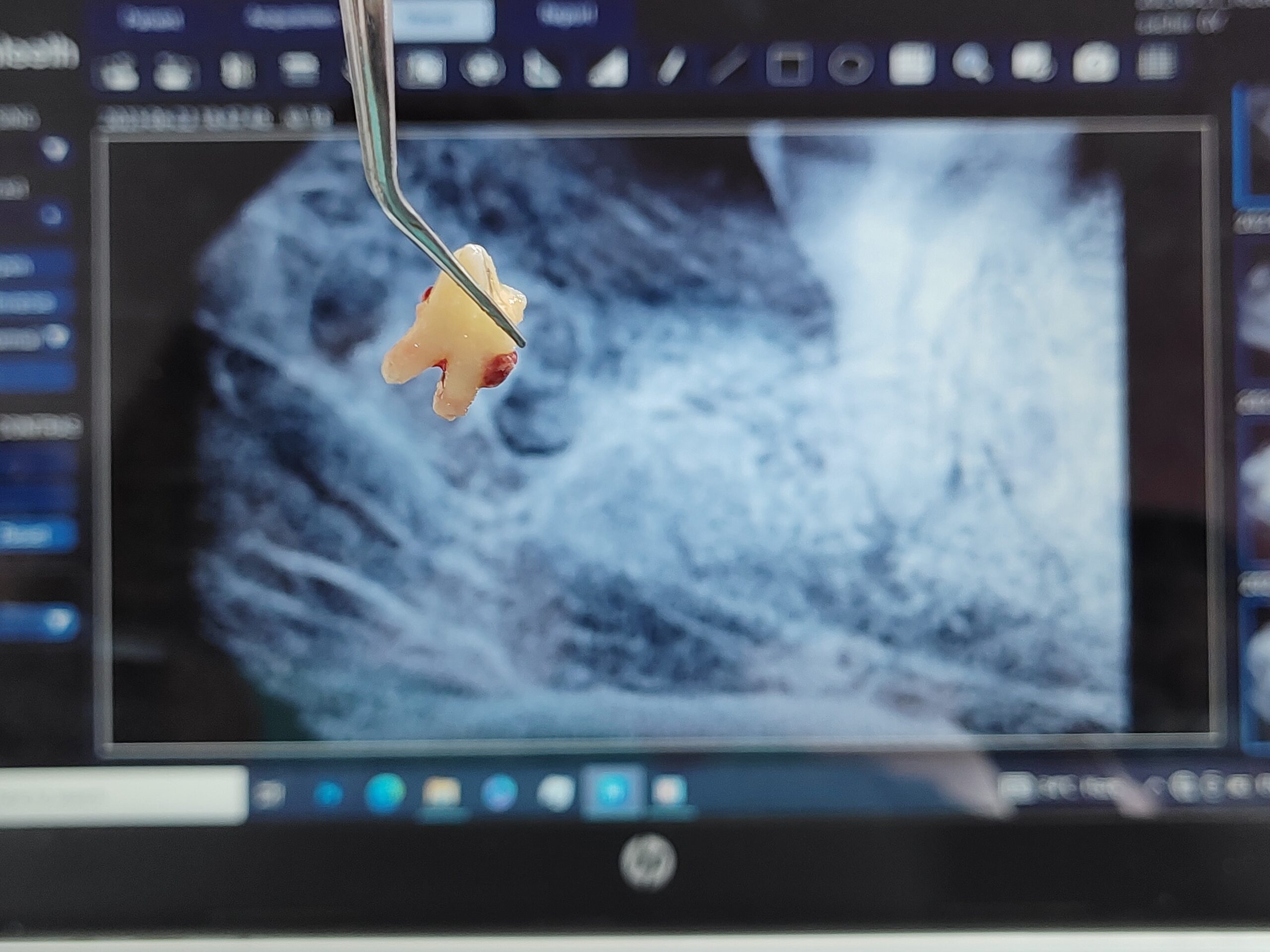 Extractions / endocare