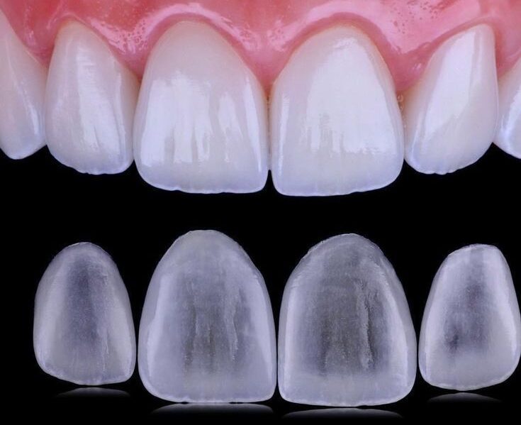 veneers / endocare