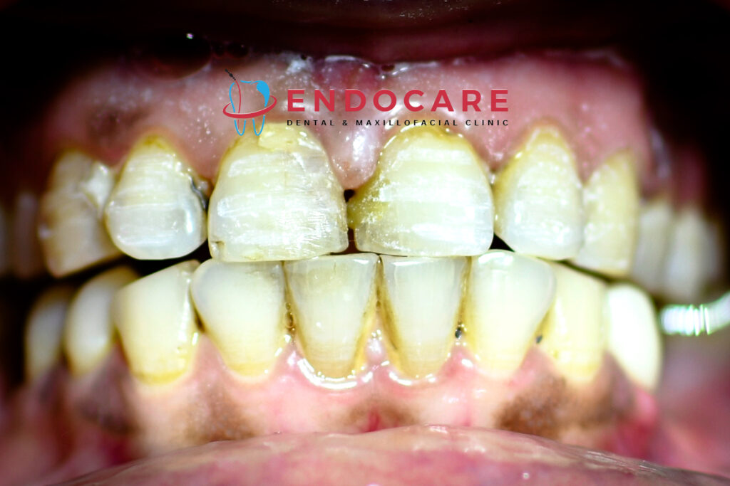 dental veneers in Lucknow