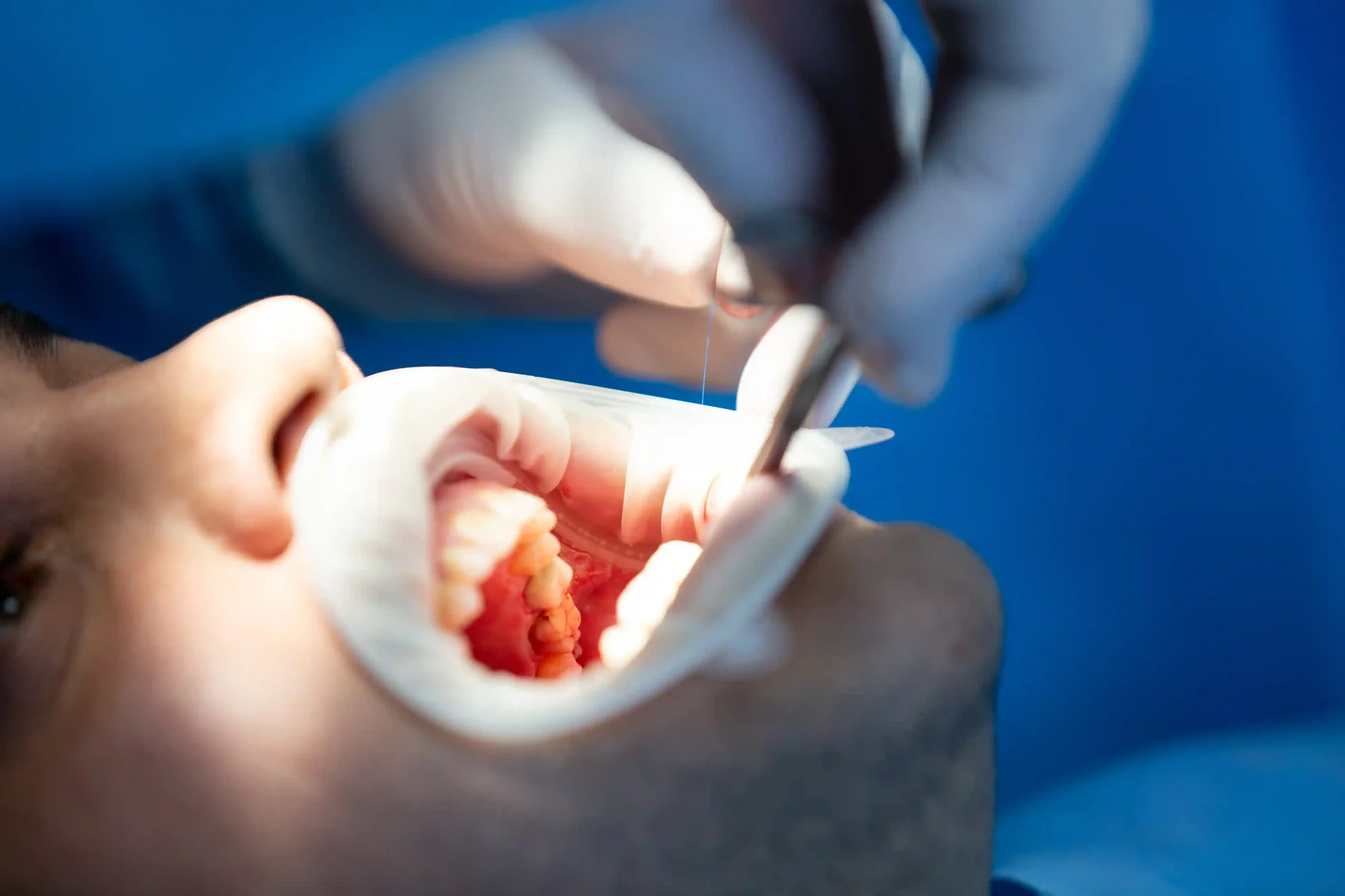 Wisdom Tooth Removal Lucknow
