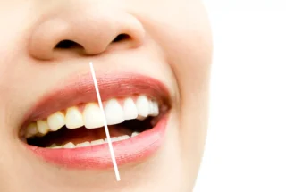 Woman Whitening Treatment In